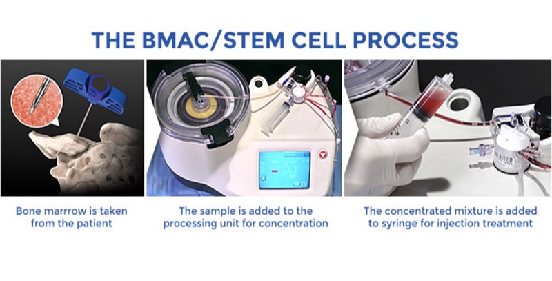 Three-step infographic showing the BMAC/stem cell process: bone marrow is aspirated from the pelvis, processed in a centrifuge, and concentrated into a syringe for injection