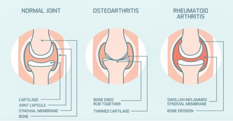 A healthy joint, an osteoarthritic joint and an inflamed joint in rheumatoid arthritis