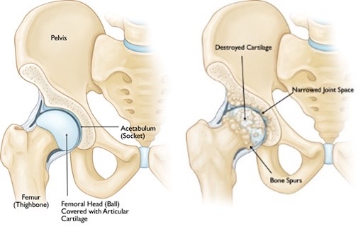 Side-by-side medical illustration of a healthy hip joint and an arthritic hip joint