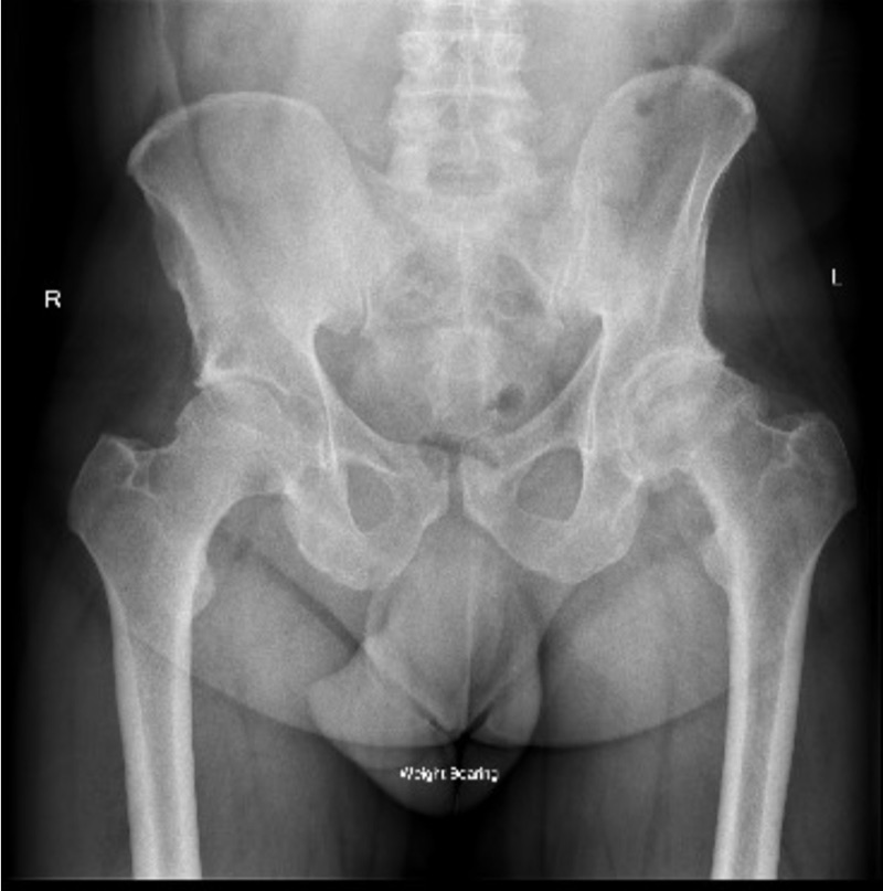 Weight-bearing AP pelvic X-ray showing the hip joints, with joint space narrowing consistent with osteoarthritis