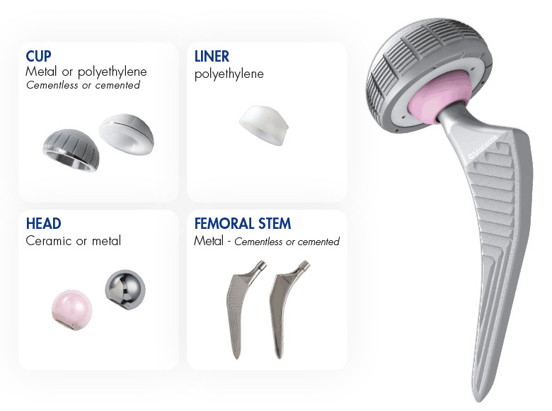 Infographic showing the four components of a total hip replacement implant: cup, liner, head and femoral stem, with an assembled 3D render