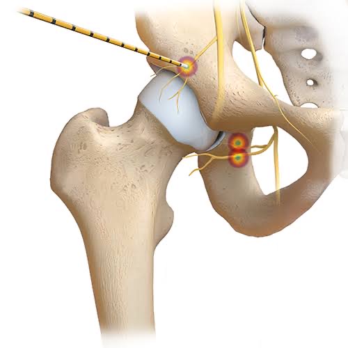 Illustration of a radiofrequency ablation procedure on a hip joint, showing a probe targeting the sensory nerve branches around the hip capsule with the pelvis, acetabulum and femoral head
