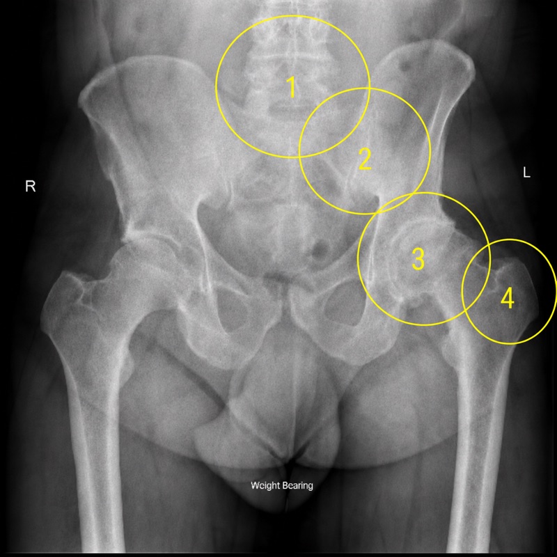 The regions of the pelvis and hip where pain is felt, and what each usually points to